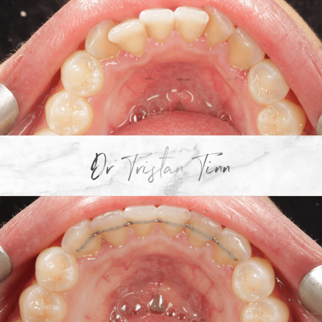 Clear Aligners
