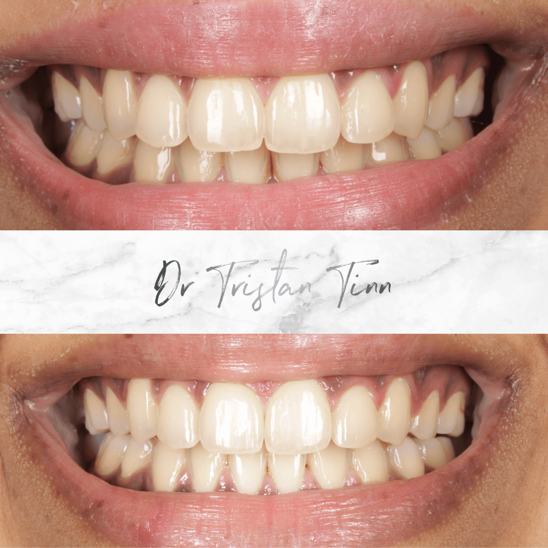 Aligners + Whitening