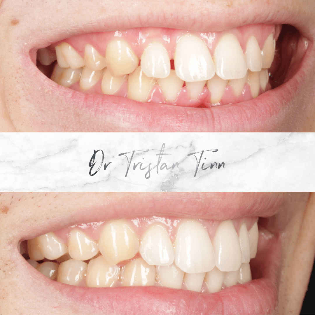 Aligners + Whitening