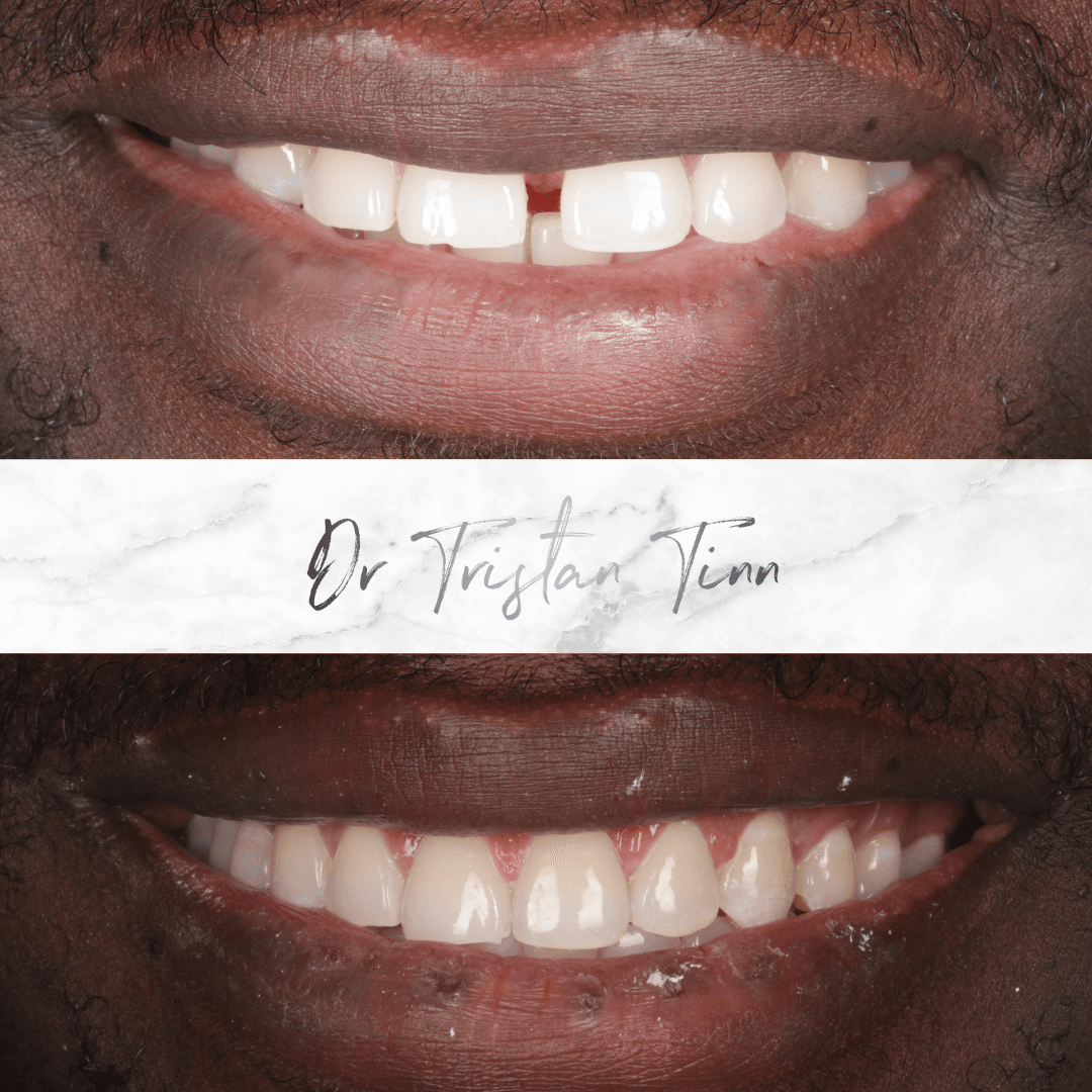 Aligners + Whitening