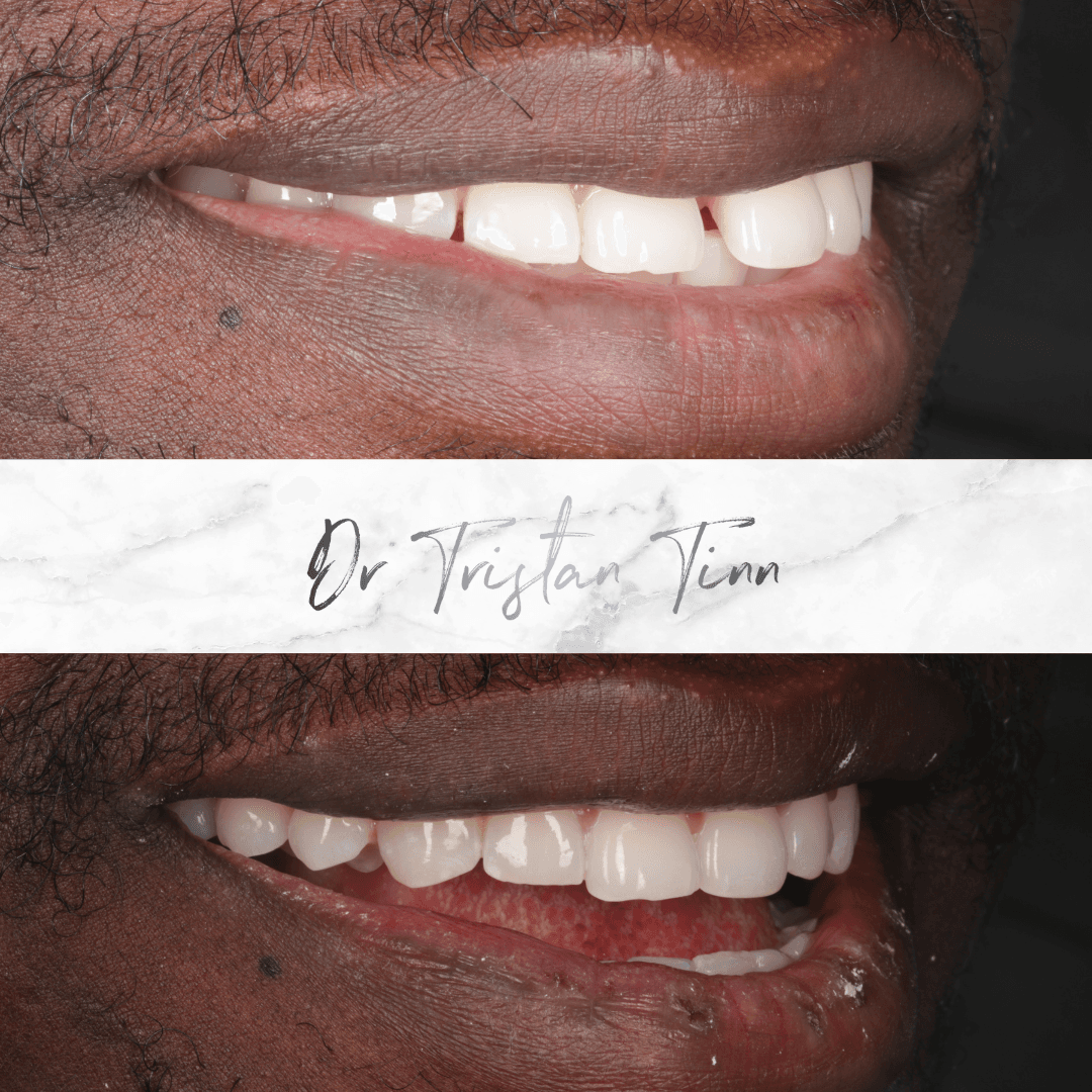 Aligners + Whitening