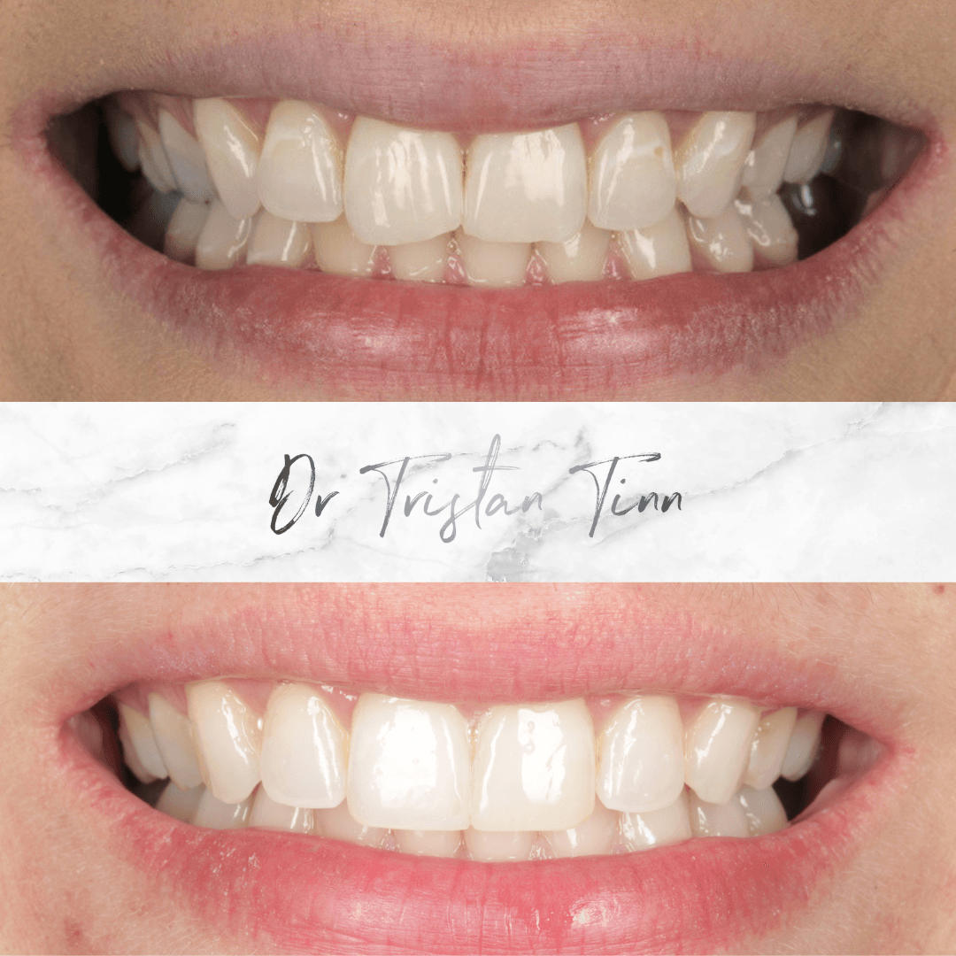 Aligners + Whitening + Bonding