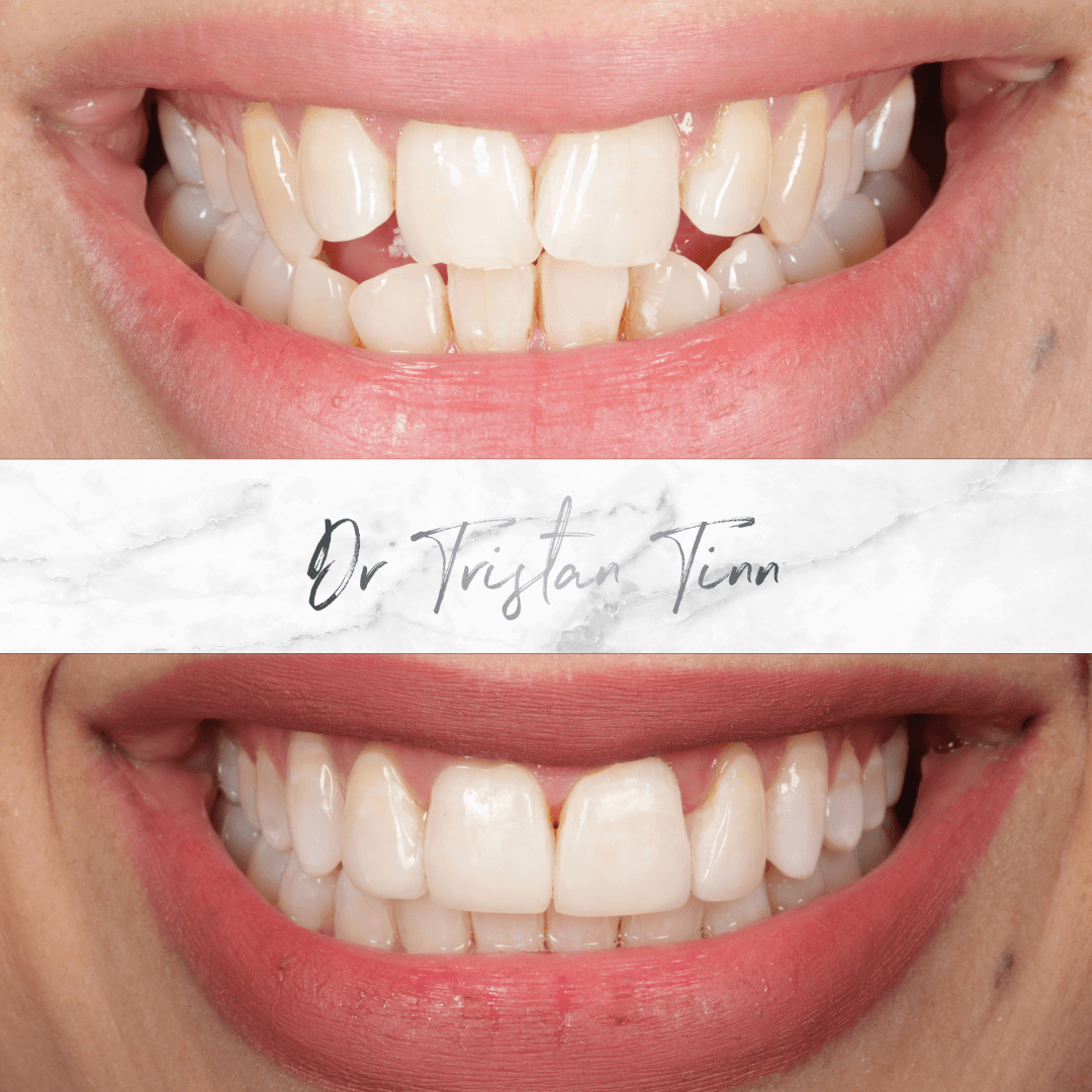Aligners + Whitening + Bonding