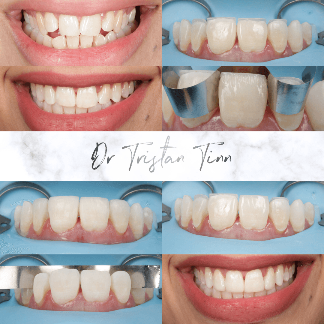 Aligners + Whitening + Bonding