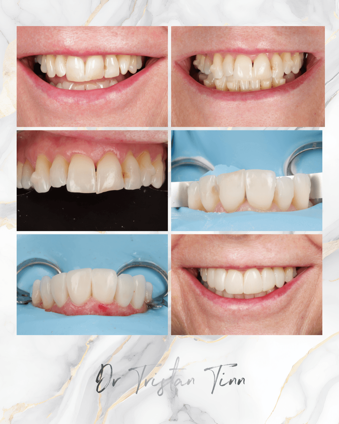 Aligners + Whitening + Bonding