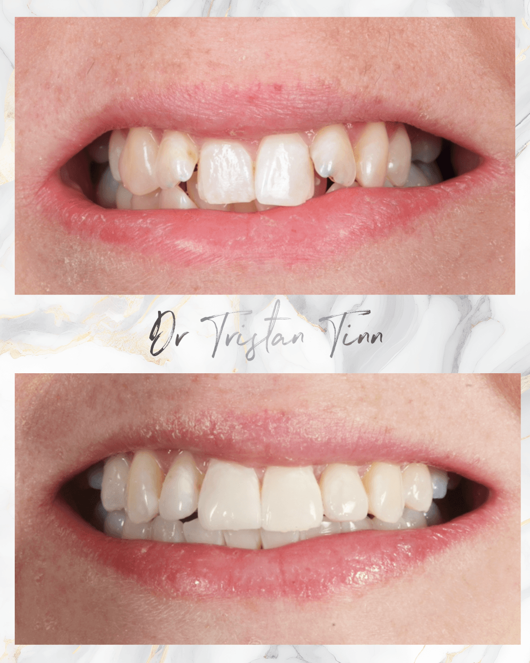 Aligners + Whitening + Bonding + Edge Bonding