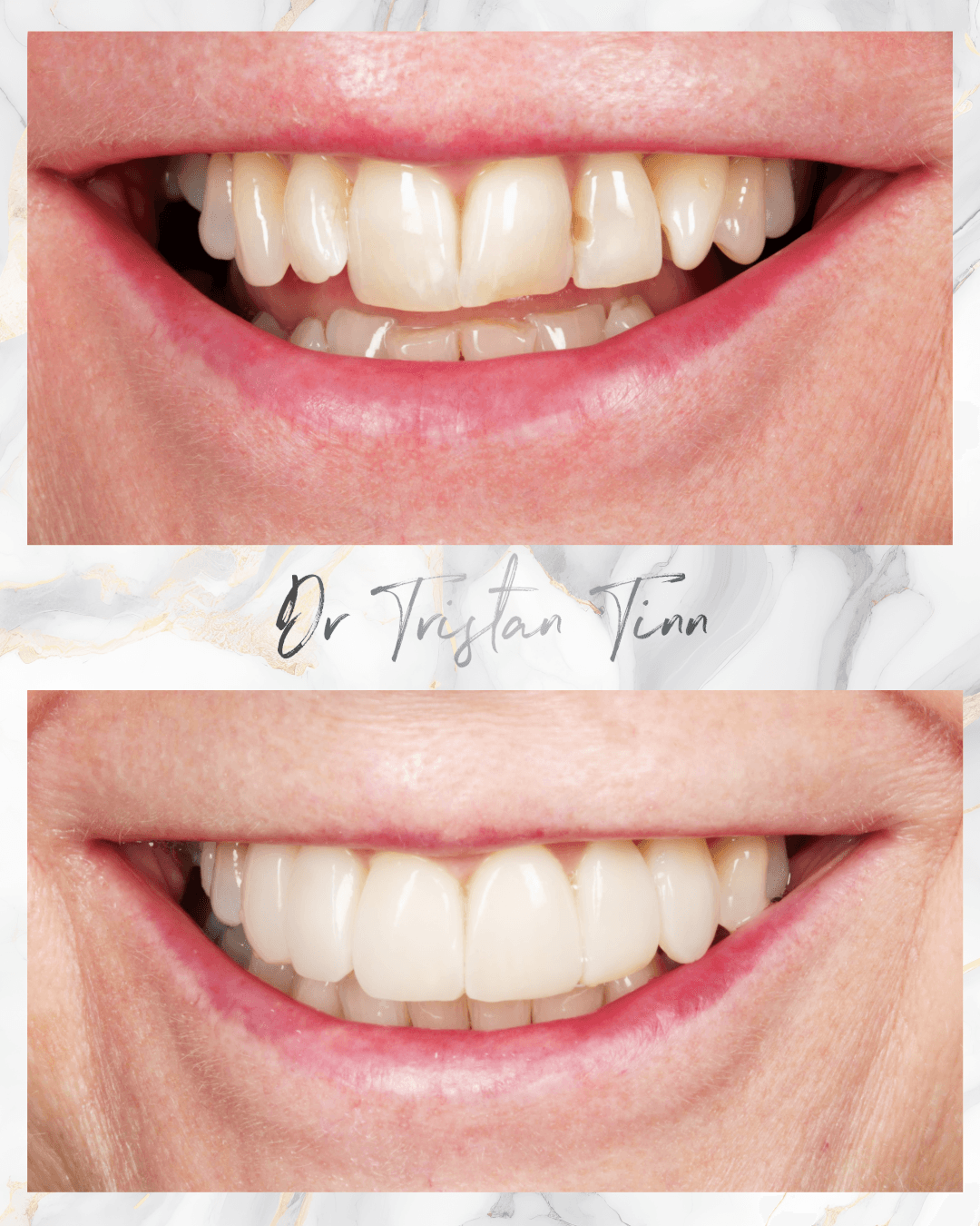 Aligners + Whitening + Bonding