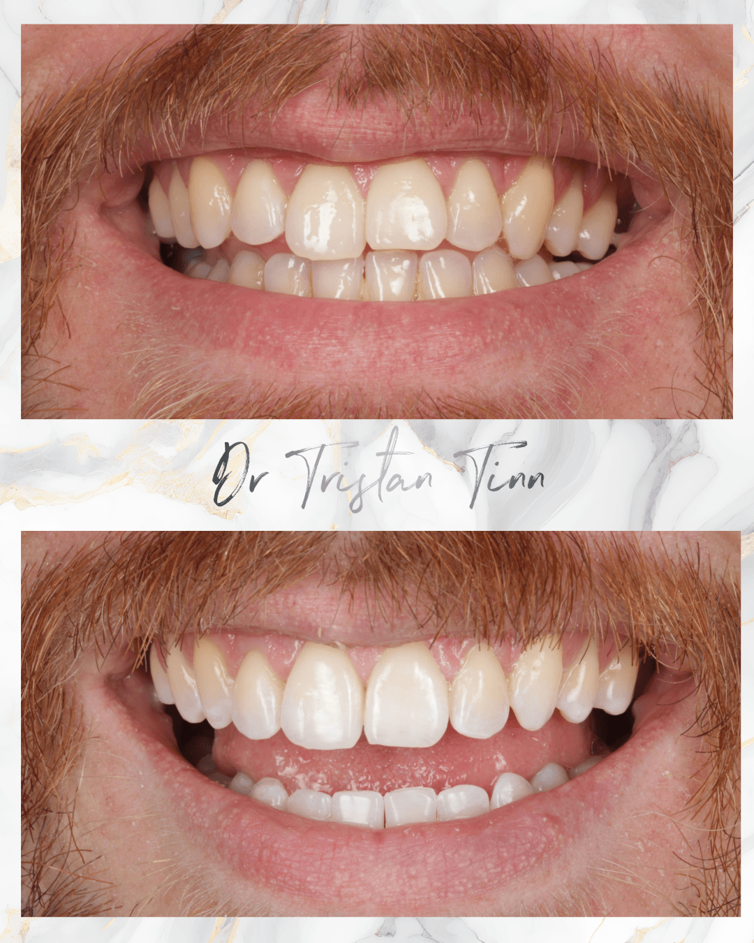 Aligners + Whitening