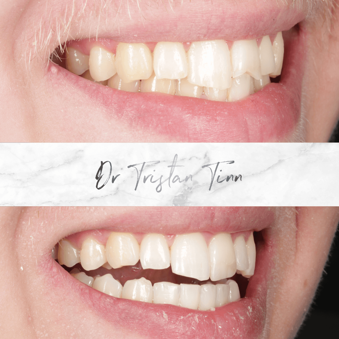 Aligners + Edge Bonding