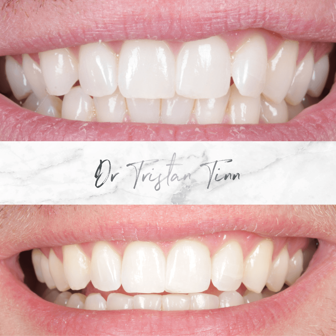 Aligners + Whitening