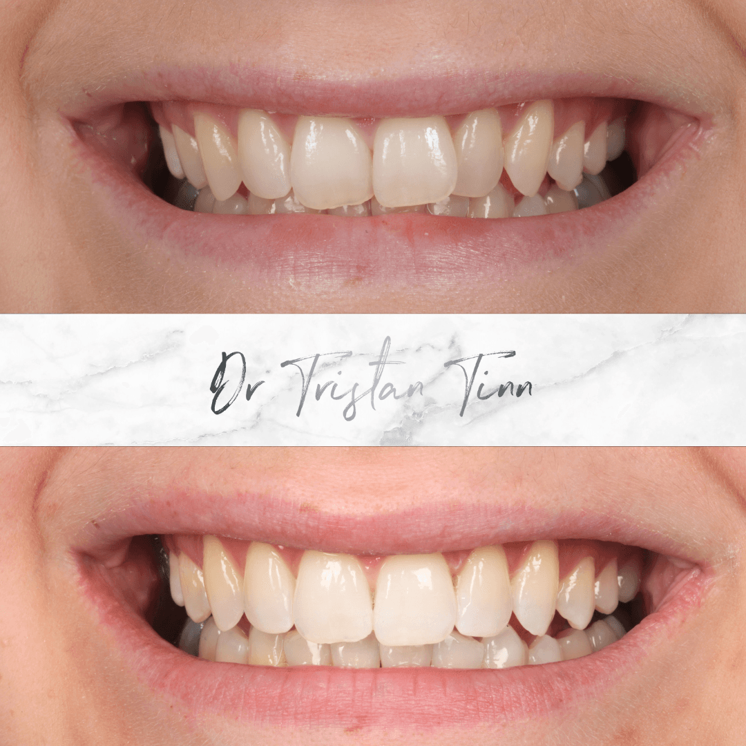 Aligners + Whitening