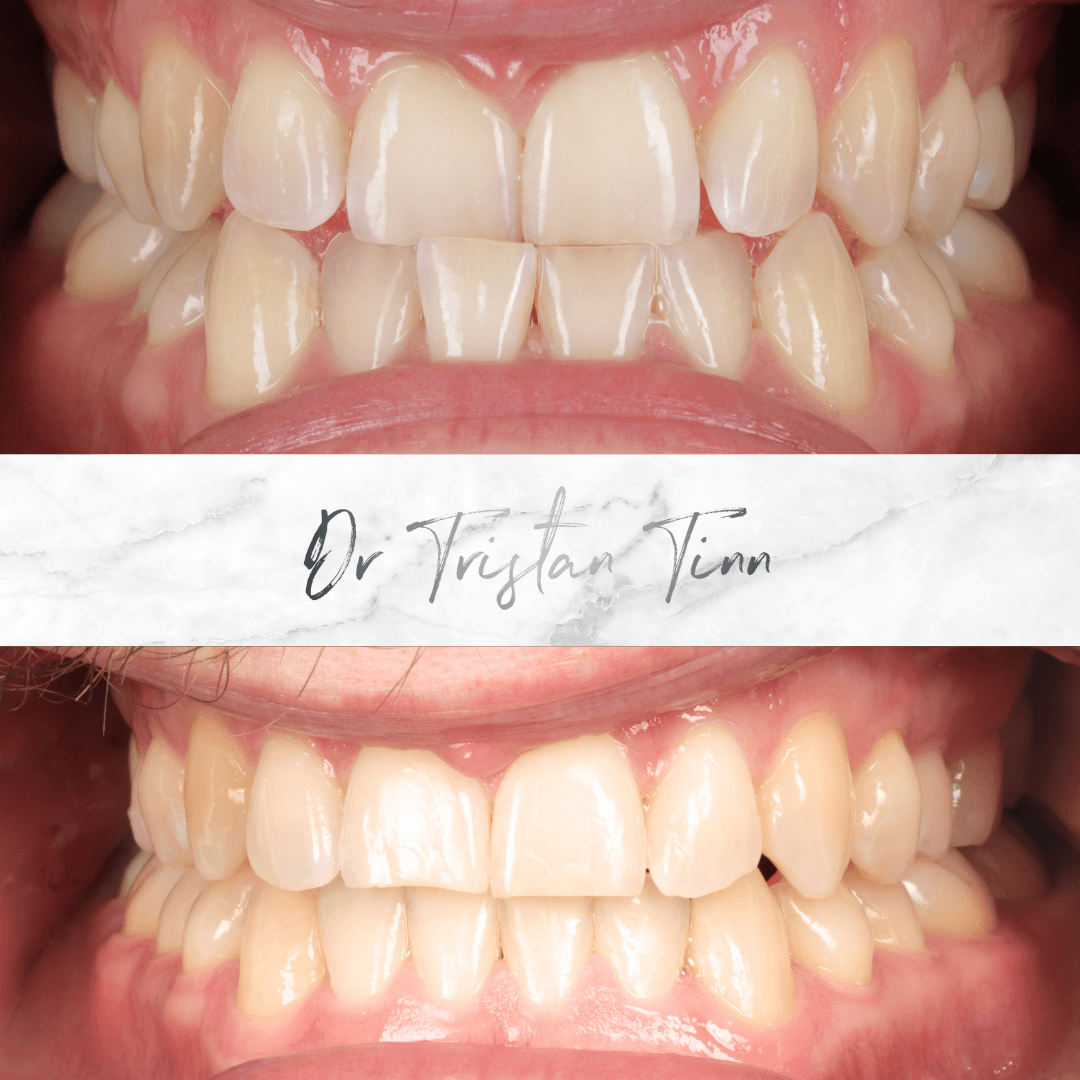 Aligners for Bite Correction