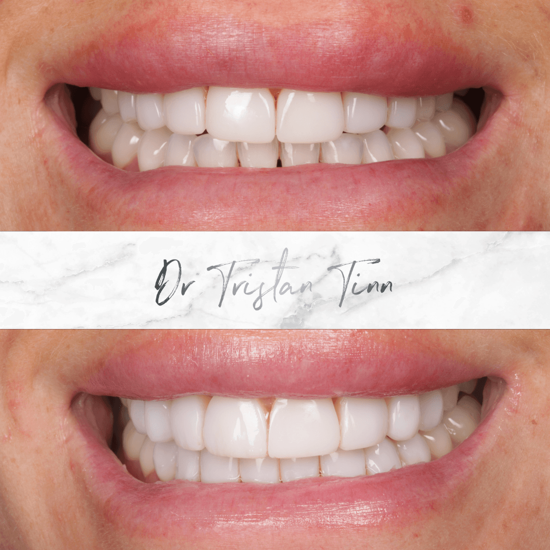 Composite Veneer Replacement