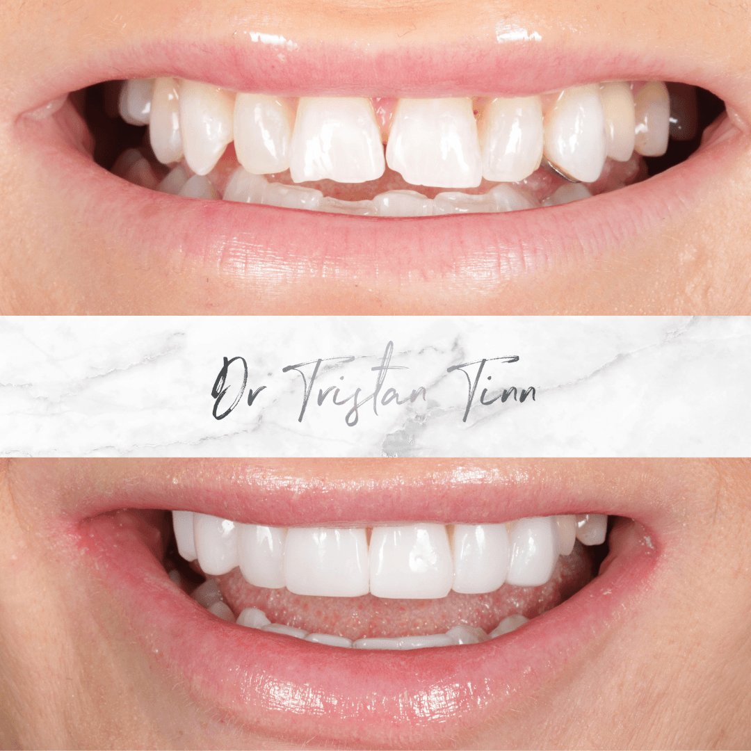 Composite Veneers