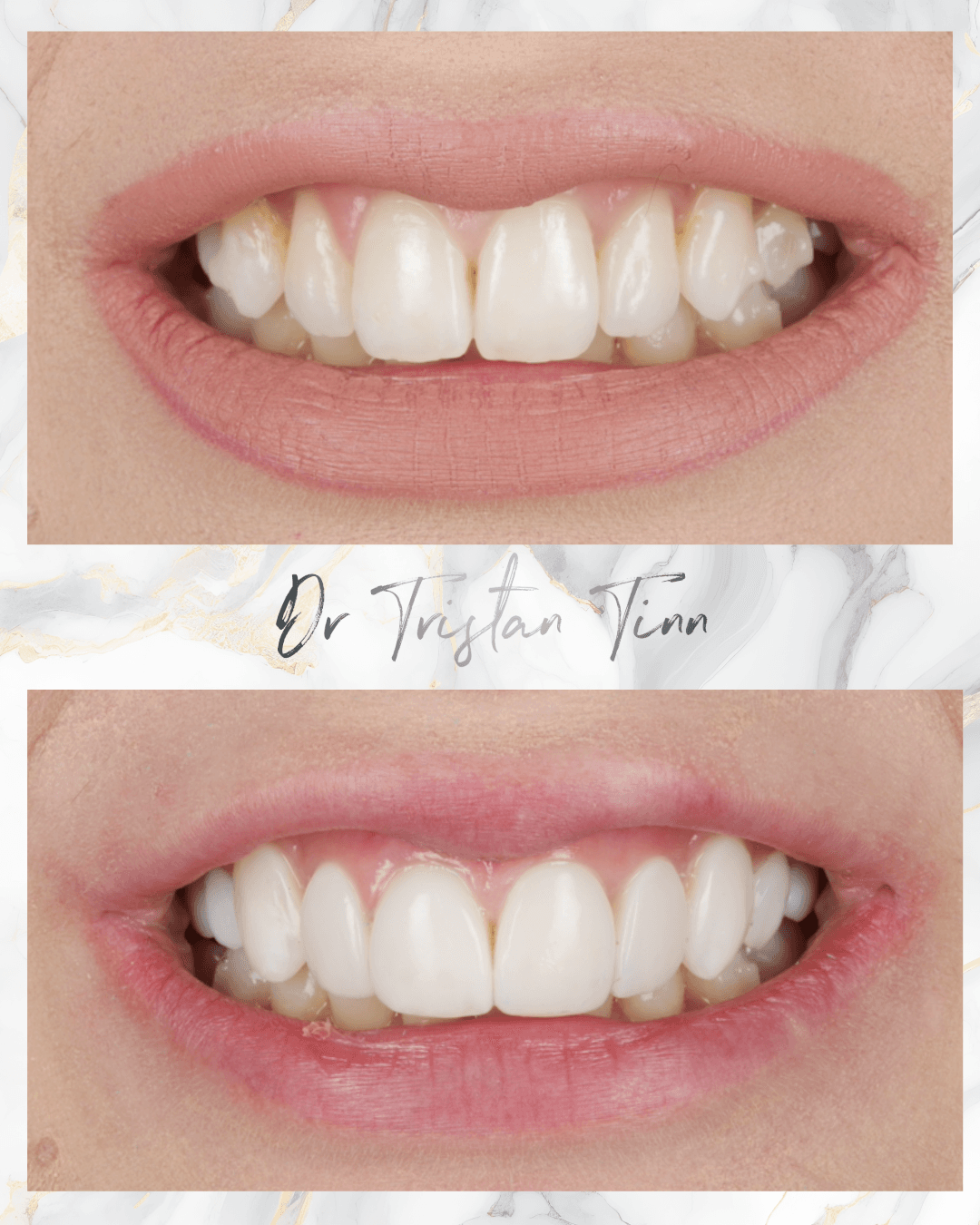 Bright White Composite Veneers