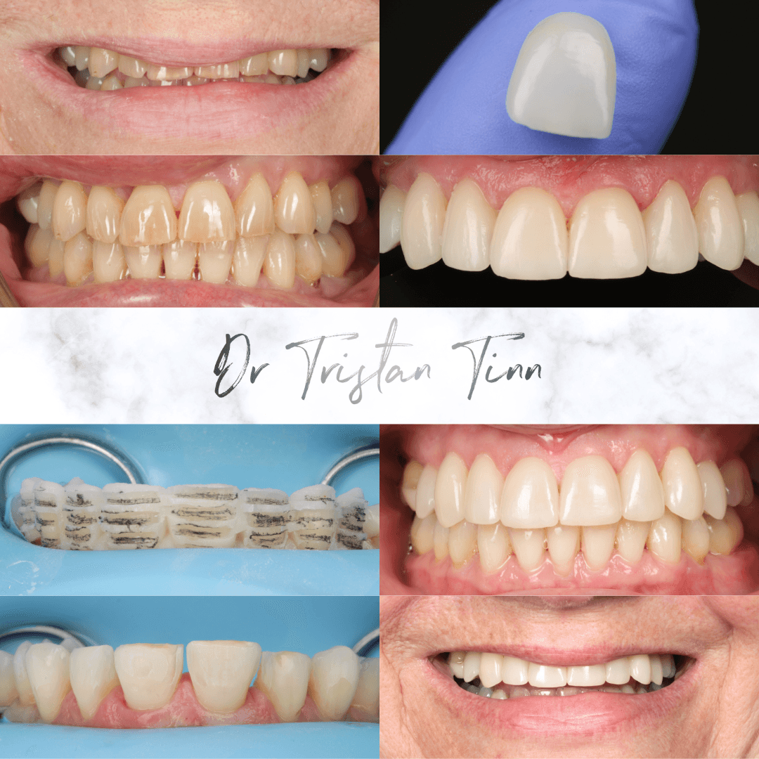 Ceramic Veneers