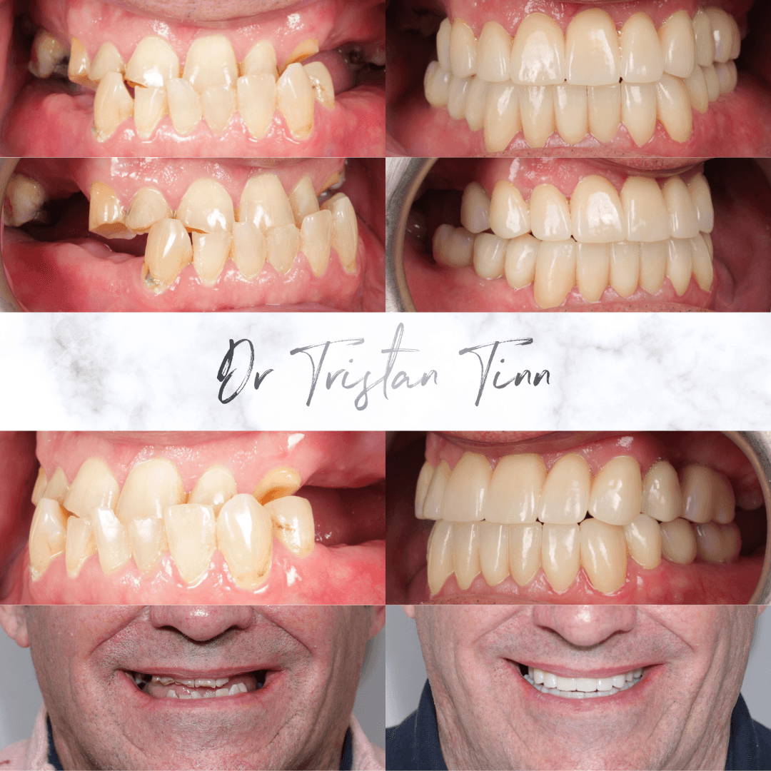 Full Mouth Crown Rehabilitation