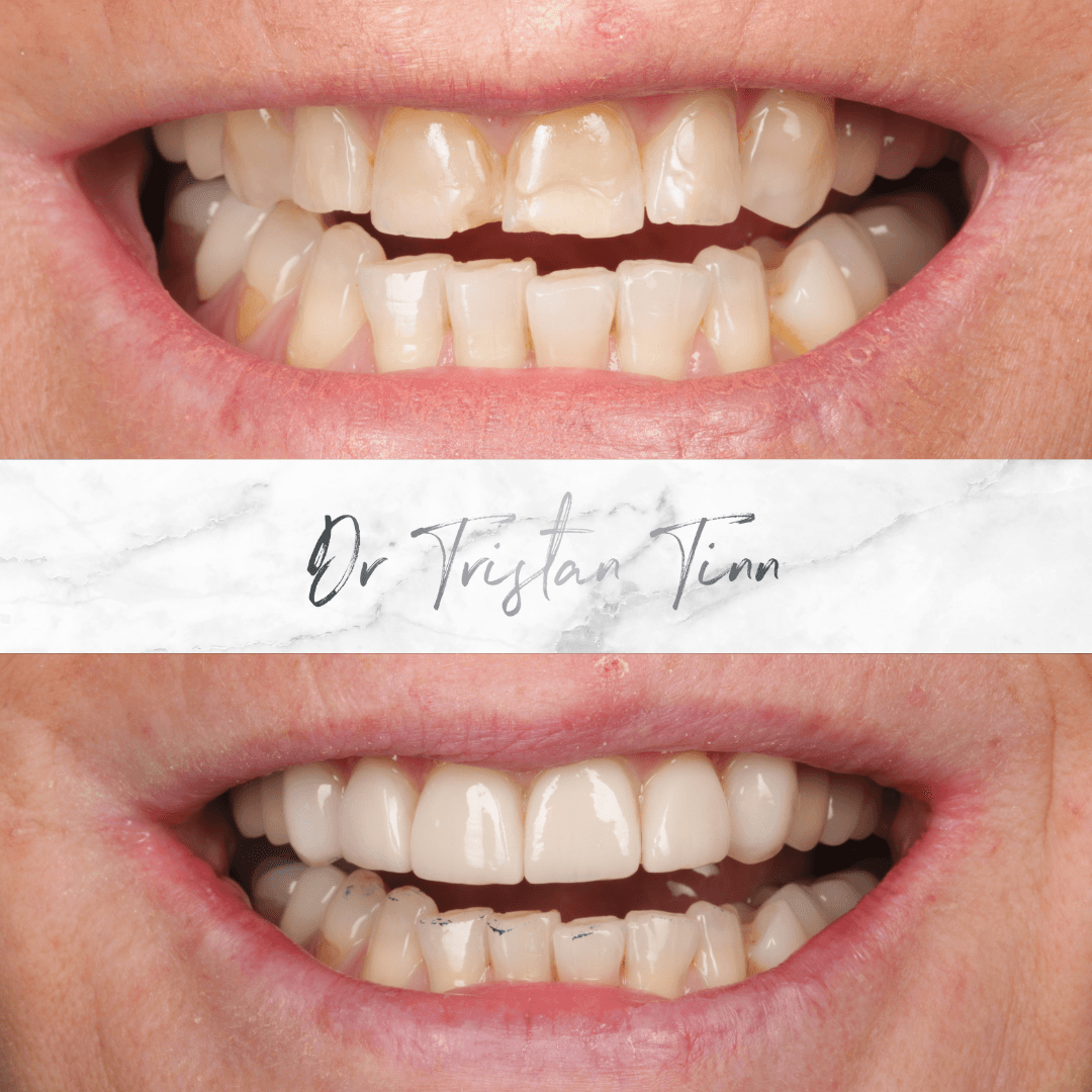 Composite Veneers for Worn Teeth