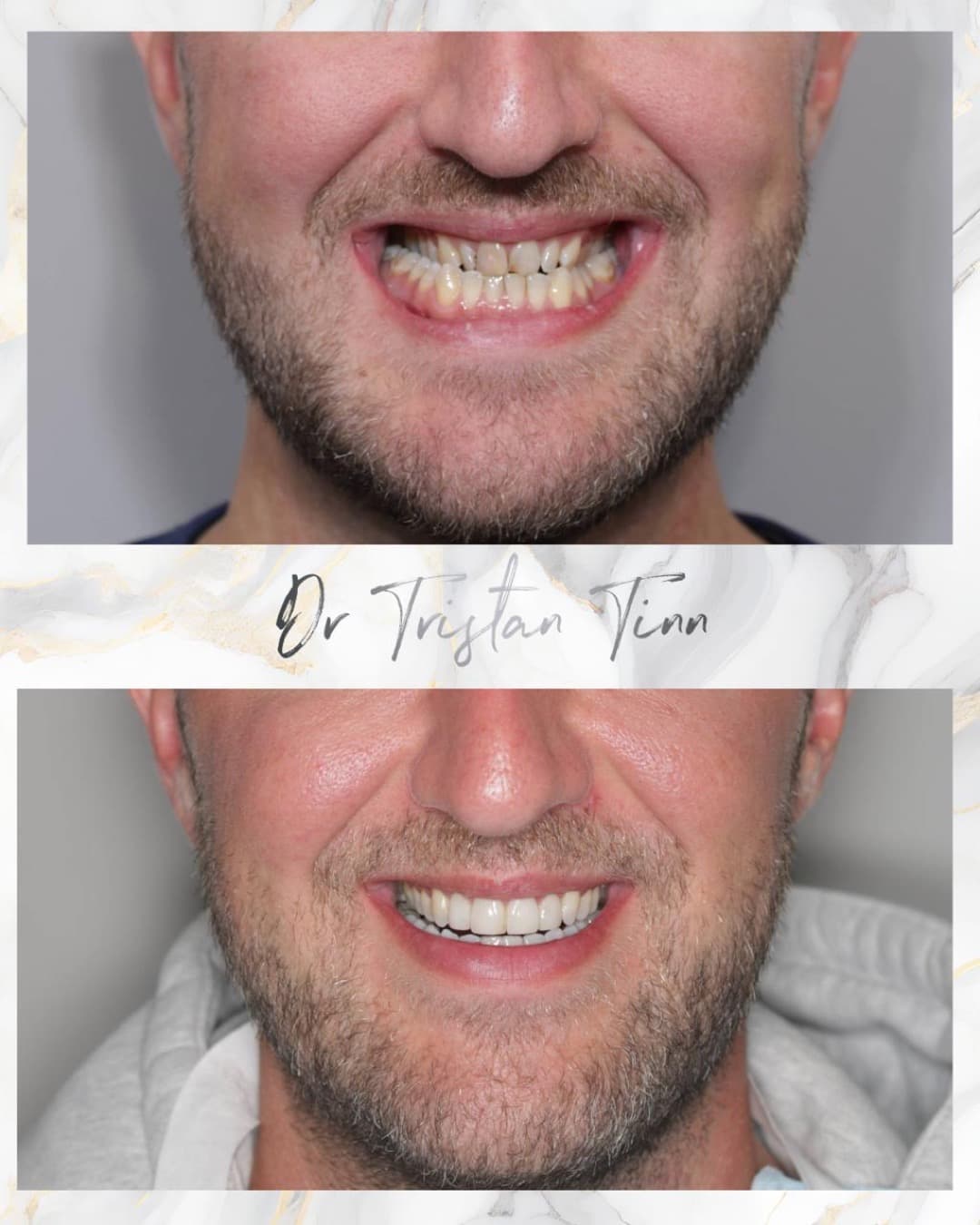 Aligners + Composite Bonding